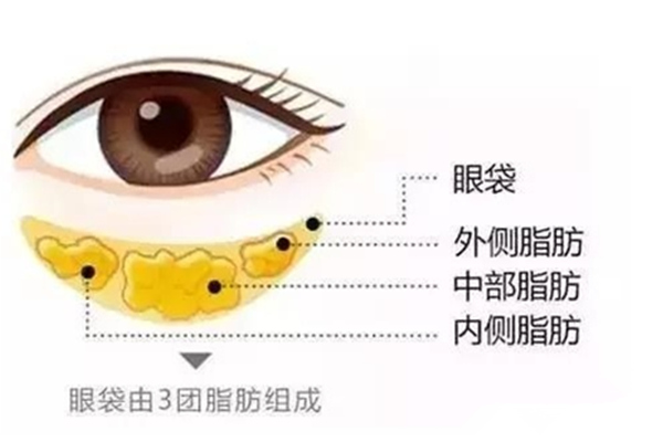 臥蠶和眼袋的區別