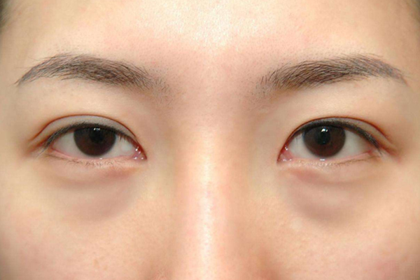 眼袋是怎么形成的