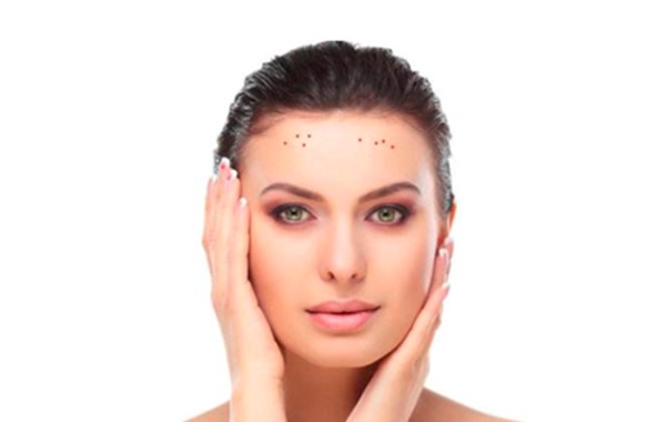 額頭長痤瘡怎么辦