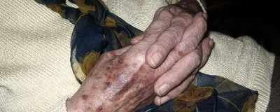 怎么預防老年斑