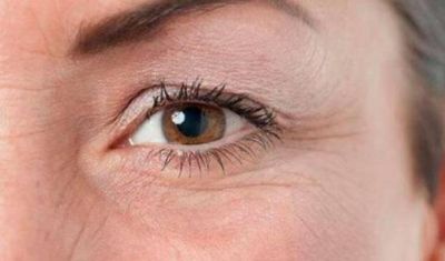 0011259211311 怎樣去除眼角魚尾紋