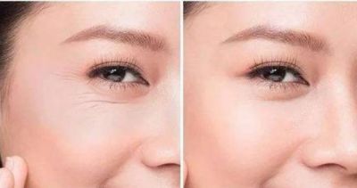 0011341311311 怎樣去除眼角魚尾紋