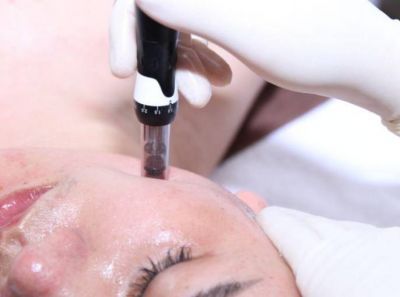 mts微針哪些人不能做