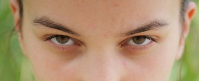 臉上長痘痘怎么快速去除