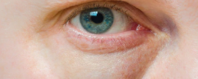 怎樣去除下眼袋