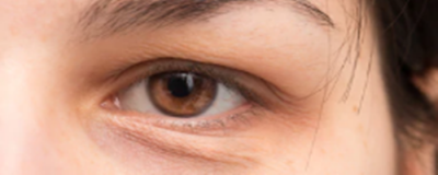 怎樣去除下眼袋