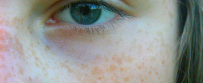 黃褐斑怎么回事