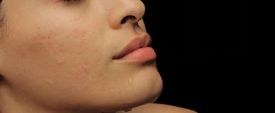 臉上長痘痘了怎么辦