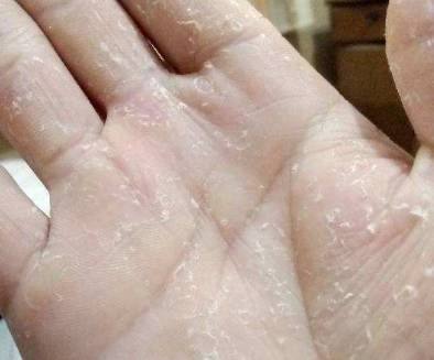 手干裂起皮怎么辦