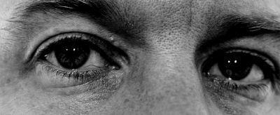 怎樣去除臉上老年斑