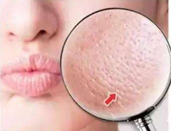 1047121211311 青春期最簡單的收縮毛孔方法