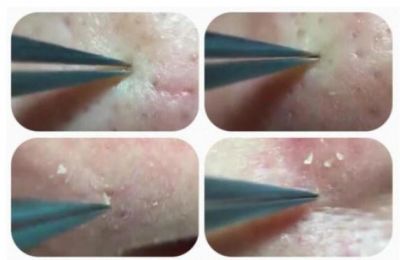 用鑷子拔黑頭毛孔會變大嗎