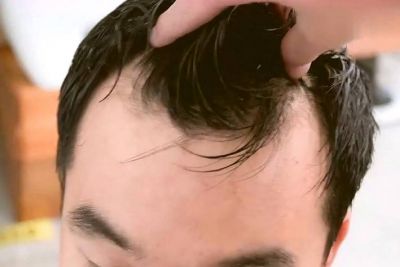 m字型發際線怎么辦