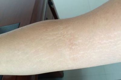 橘皮紋和肥胖紋都有什么區別