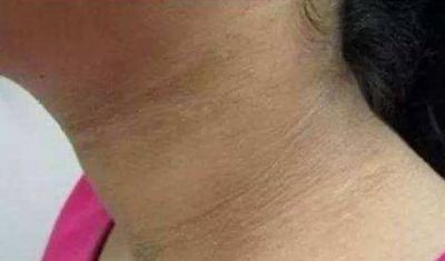 脖子黑怎么有效變白的方法