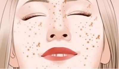 孕婦長雀斑怎么會遺傳嗎