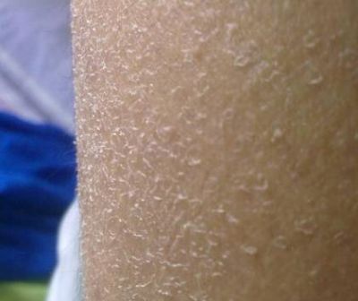 冬天洗澡后有皮屑是怎么辦