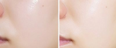 菌菇水為什么叫爛臉水