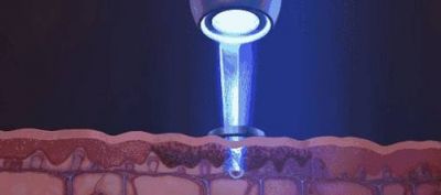 1351246511311 做完皮秒祛斑幾天可以洗臉