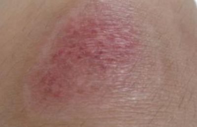 脫痂后紅印可以擦粉底嗎