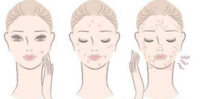 臉頰兩邊老是長痘痘是怎么回事