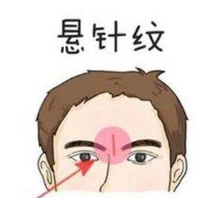 1523256411311 懸針紋怎么去除小偏方