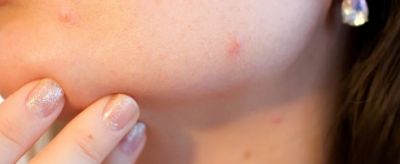 1531359311310 怎樣去除青春痘疤痕