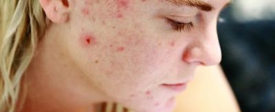 1531368911310 怎樣去除青春痘疤痕