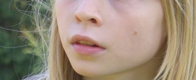 1531509111310 怎樣去除青春痘疤痕