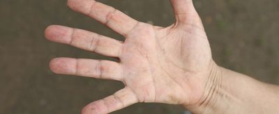 手掌皮膚粗糙怎么辦