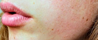 皮膚干燥起皮怎么辦