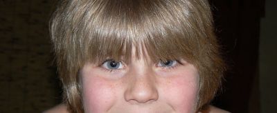 1644229411310 雀斑是怎么形成的