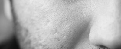 臉上的毛孔大怎么辦