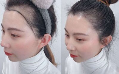 再生發際線真的可以再生么