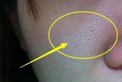 皮膚毛孔大怎么解決