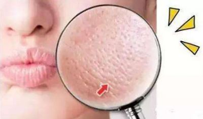 皮膚毛孔大怎么解決