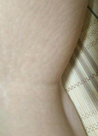 皮膚撐開長紋怎么消除