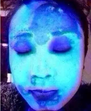 1712003711311 熒光劑的臉會出現什么癥狀