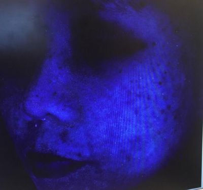 1712111411311 熒光劑的臉會出現什么癥狀