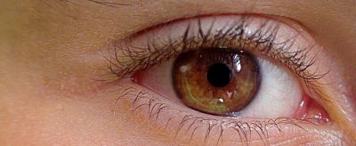 怎么去除眼睛紅血絲