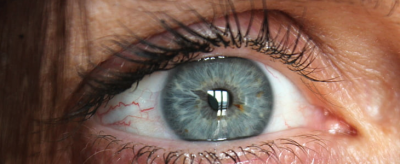 怎么去除眼睛紅血絲