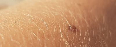 1726381311310 可以永久性脫毛嗎