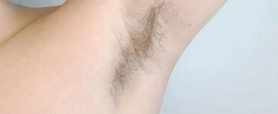 1726382011310 可以永久性脫毛嗎