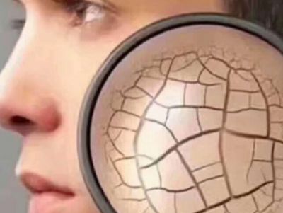 皮膚缺水會有什么樣的后果