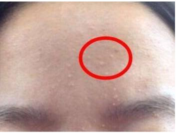 1749309611311 額頭老是長閉口是什么原因