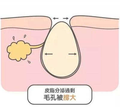 改善臉部毛孔粗大方法