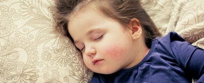 皮膚有紅血絲怎么辦