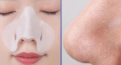 鼻子上的黑頭直接擠掉可以嗎