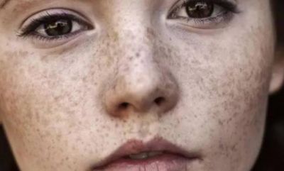 祛完斑應該注意什么