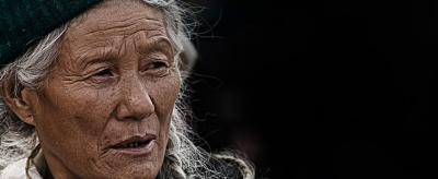 臉上黑斑怎么去除